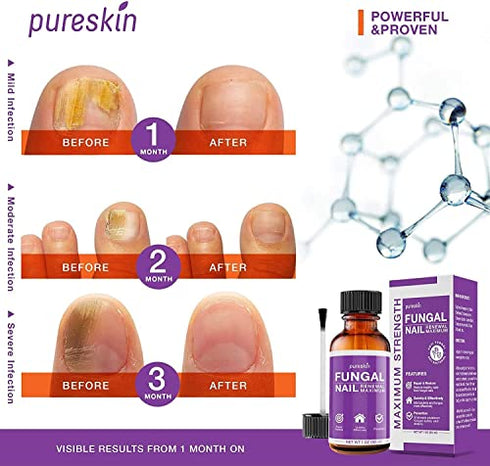 pureskin Fungal Nail Renewal - Maximum Strength Nail Fungus Treatment, Toe Fungus Nail Treatment, Health Care Solution for Finger & Toenail Fungus, Athlete's Foot, Ringworm by Fungus