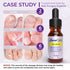 ZanaQuick Toenail Fungus Treatment Drops - 2 Pack - Nail Fungus Treatment For Toenail Remedy, Powerful Nail Fungus Treatment For Fingernail & Toenail